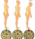 Barbara-Hannah_photo-osteoprosis