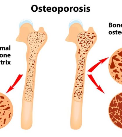 Better BonesBetter Bones - LivingBetter50